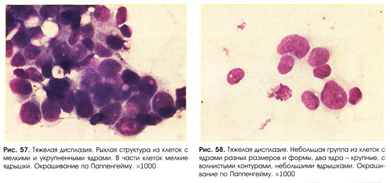 Клетки шейки матки. Дисплазия тяжелой степени цитология. Дисплазия мазок цитология. Дисплазия онкоцитология. Дисплазия атипичные клетки.