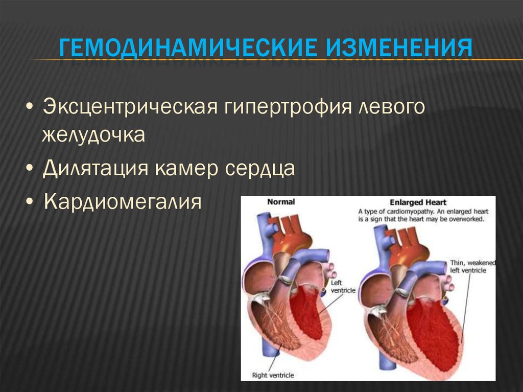 Изменения миокарда левого желудочка сердца. Концентрическая гипертрофия миокарда. Сердечная недостаточность гемодинамические изменения. Эксцентрическая гипертрофия сердца. Гипертрофия левого желудочка.