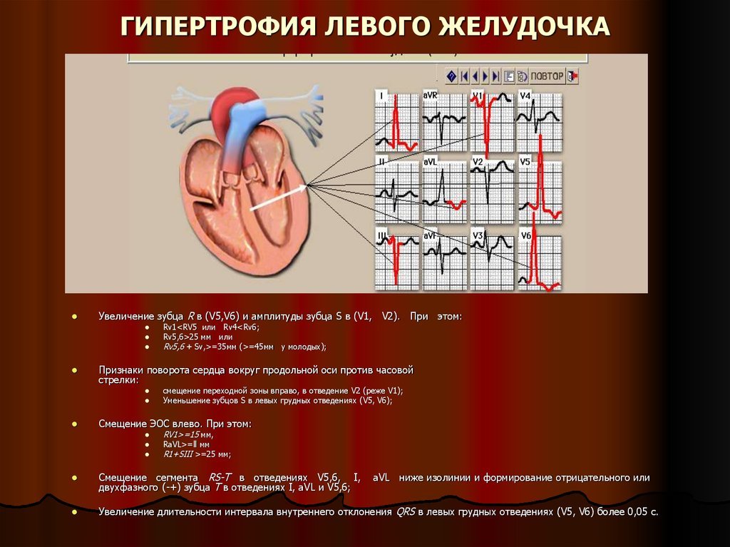 Гипертрофия левого желудочка лечение