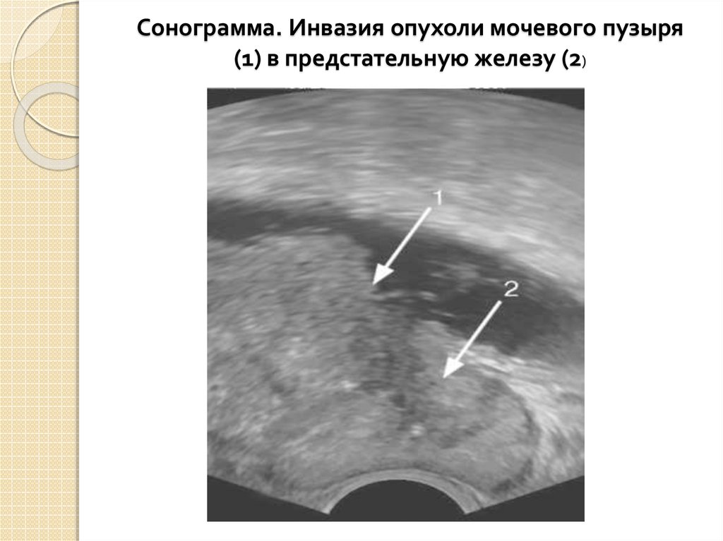 Рак мочевого. Сонограмма мочевого пузыря. Опухоль мочевого пузыря сонограмма. Фиброма мочевого пузыря. Объемное образование мочевого пузыря.