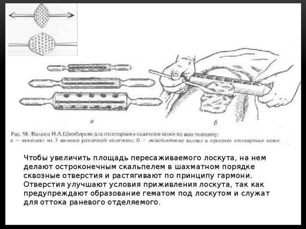 Свободный лоскут. Пересадка кожи свободная перемещением по в.п.Филатову. Свободная пересадка расщепленной кожи. Свободная пересадка кожи ЧЛХ. Свободная пересадка комбинированных трансплантатов.