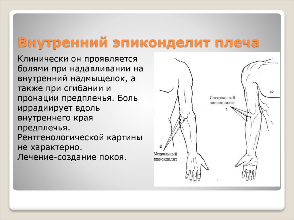Ноющая боль в плеча лечение. Болит предплечье правой руки. Боль в предплечье спереди. Болит внешняя сторона предплечья. Причины боли в предплечье.