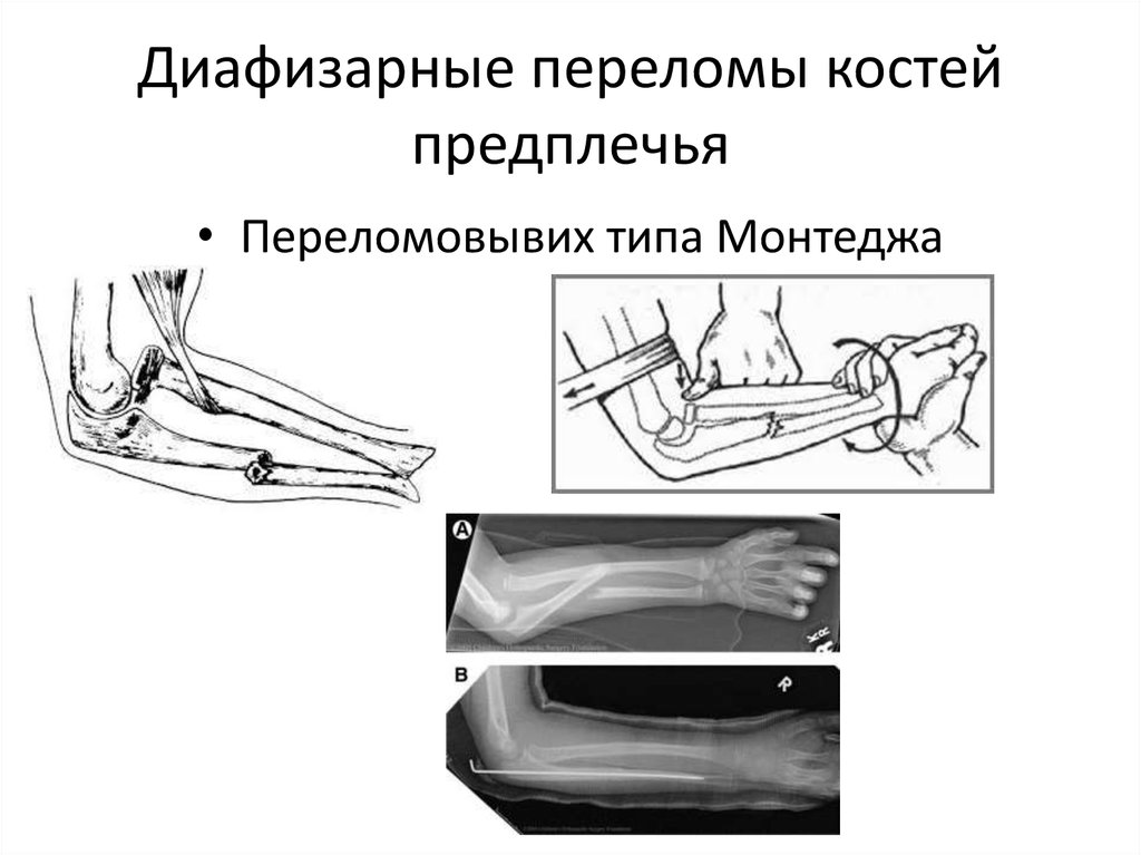 Перелом костей предплечья. Перелом диафиза костей предплечья. Диафизарный перелом обеих костей предплечья. Классификация диафизарных переломов предплечья. Вправление перелома Монтеджи.