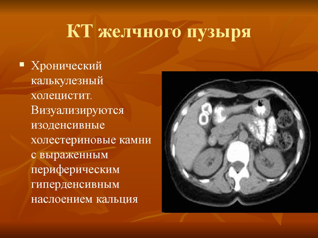 Калькулезный холецистит код по мкб 10