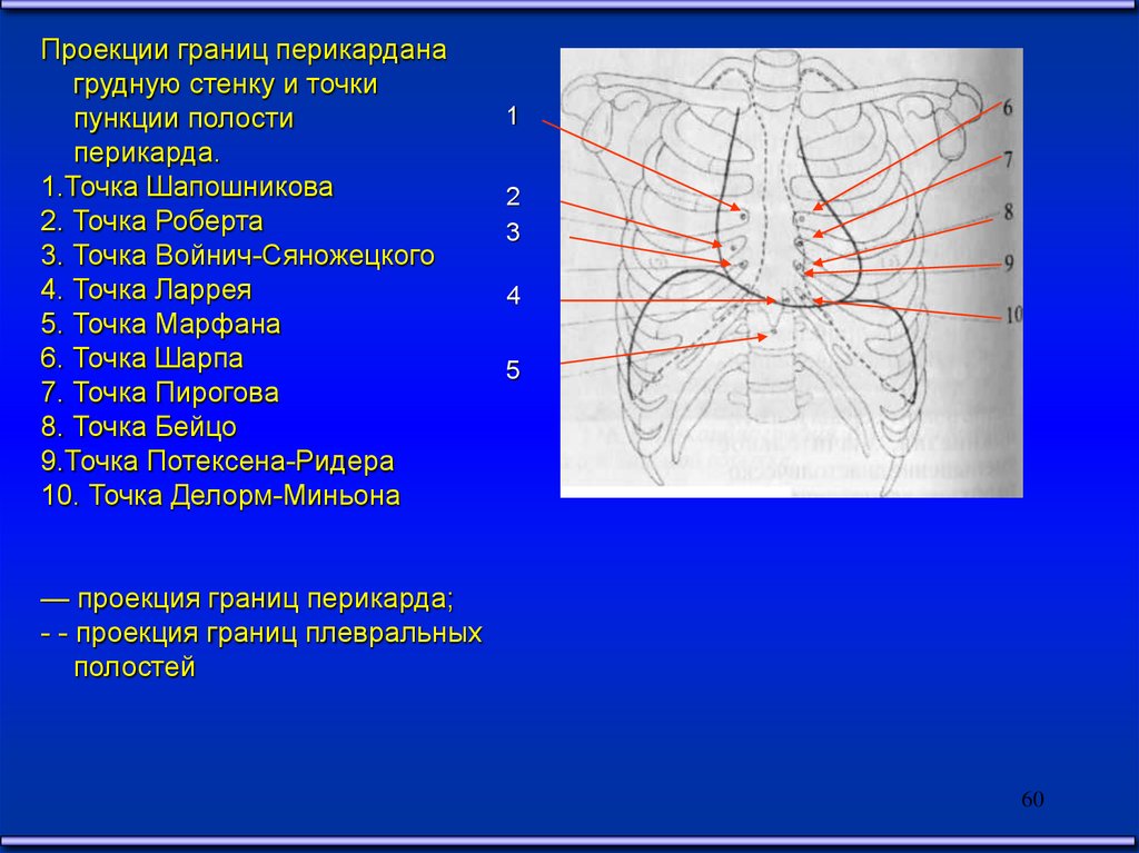 Границы проекции. Точка пункции перикарда по Ларрею. Пункция перикарда по Марфану. Пункция перикарда по Ларрею техника. Схематично типичные точки для пункции перикарда через диафрагму..