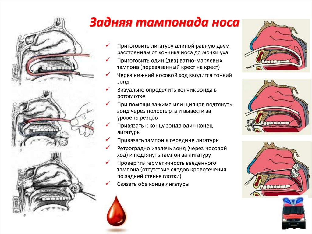 На каком из рисунков наиболее правильно показан метод остановки кровотечения из носа