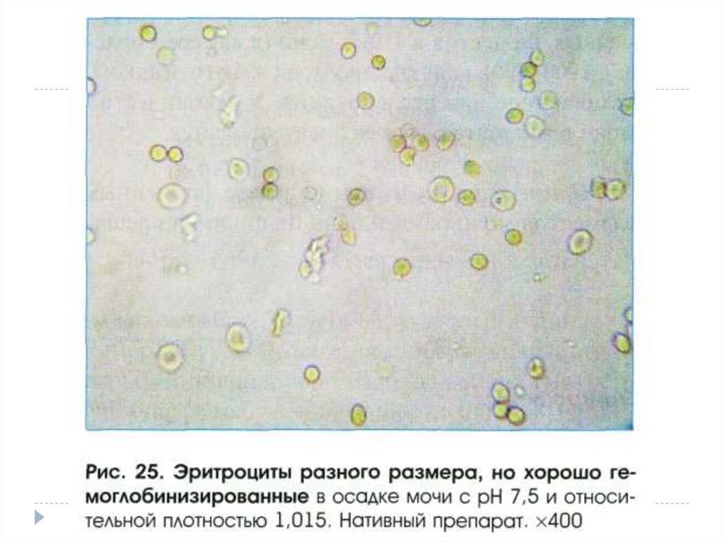 Повышенные эритроциты в моче. Микроскопия кала эритроциты. Эритроциты в осадке мочи. Микроскопия осадка мочи эритроциты. Эритроциты в секрете простаты.