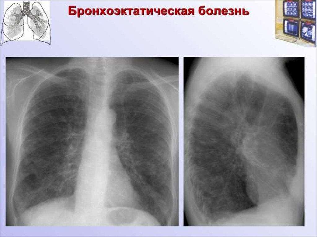 Деформирован легочный. Ячеистая деформация легочного рисунка рентген. Сетчатая деформация легочного рисунка рентген. Легочный рисунок деформирован. Патология легочного рисунка.