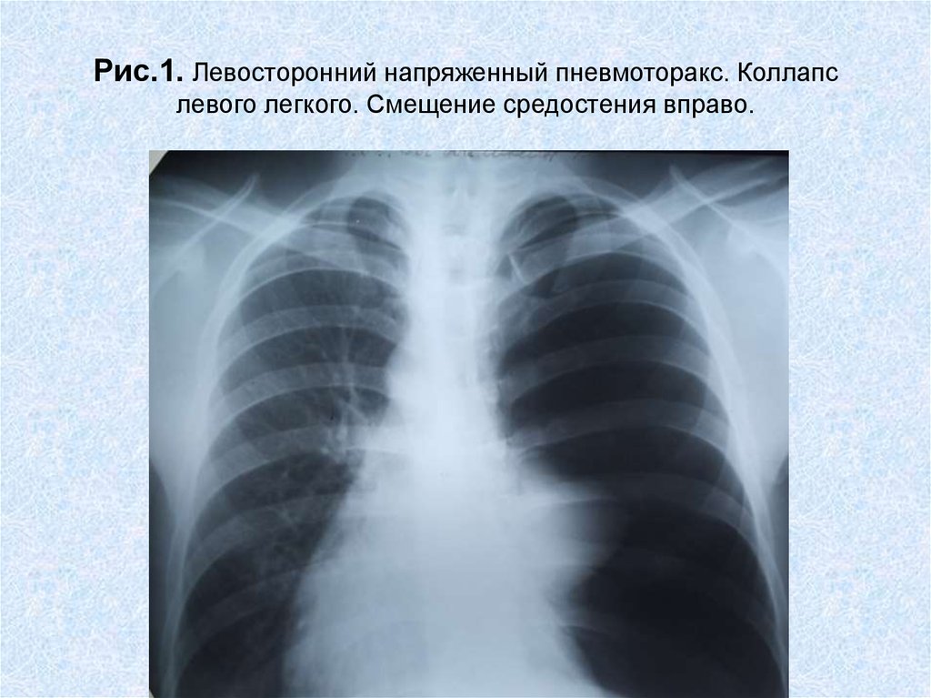 Напряженный пневмоторакс. Пневмоторакс рентген смещение средостения. Смещение средостения на рентгене. Рентген при пневмотораксе смещение средостения. Напряженный пневмоторакс рентгенограмма.