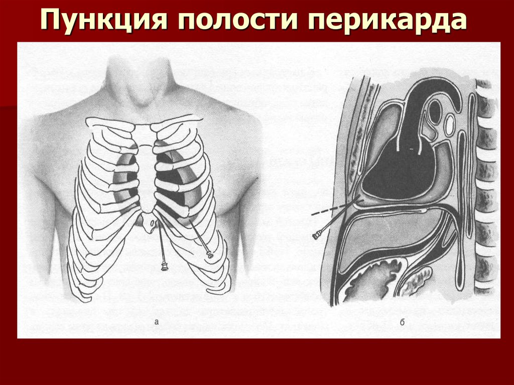 Полость перикарда. Парастернальная пункция перикарда. Пункция полости перикарда,плевральной полости. Пункция перикарда через диафрагму. Пункция перикарда (перикардиоцентез).