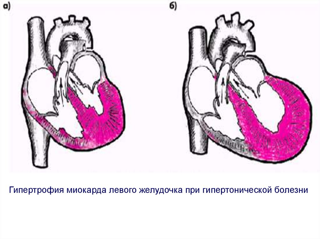 Гипертрофия левого желудочка что это. Гипертрофия левого миокарда левого желудочка сердца. Гипертрофия, миокарда, левого желудочка, желудочка.. Гипертрофия левого желудочка при гипертонической болезни. Гипертрофия левого желудочка с изменениями миокарда.
