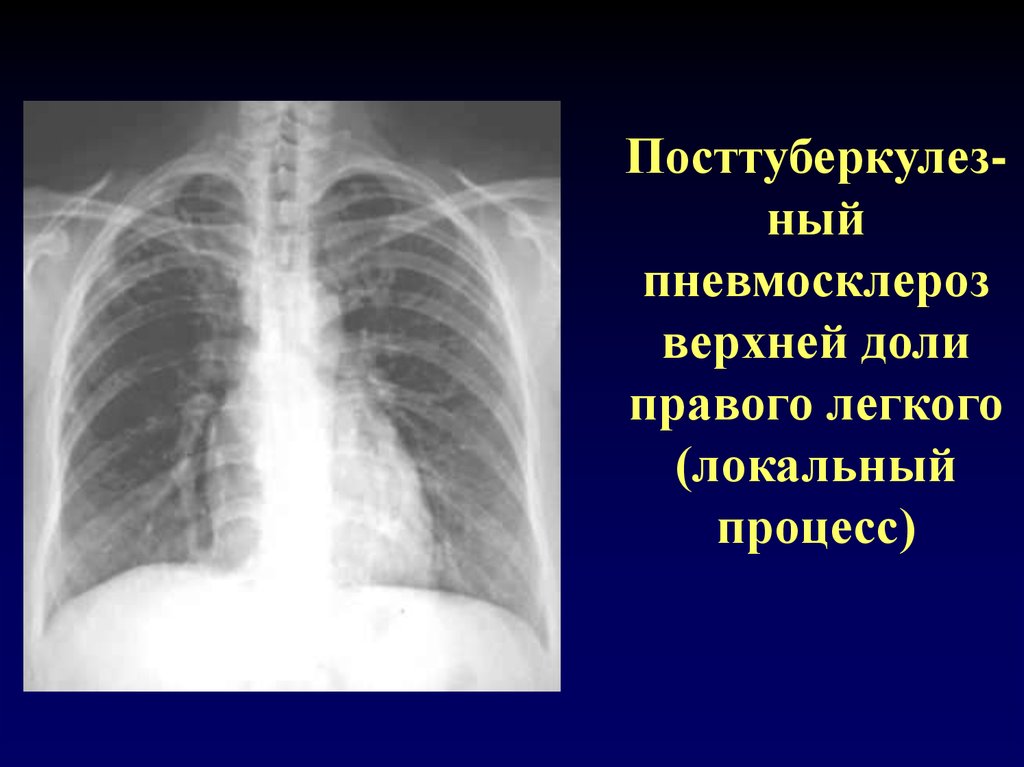 Легочный рисунок сгущен. Посттуберкулезный пневмосклероз. Пневмосклероз рентген.