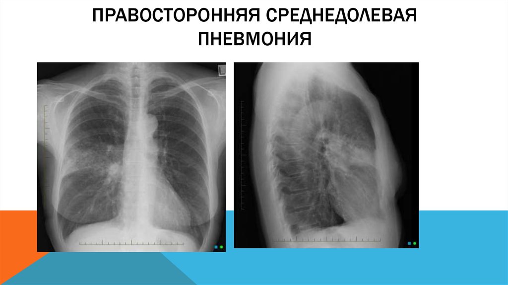 Правая пневмония. Правосторонняя среднедолевая пневмония рентген. Долевая пневмония рентген. Среднедолевая пневмония на рентгенограмме. Рентген правосторонней среднедолевой пневмонии.