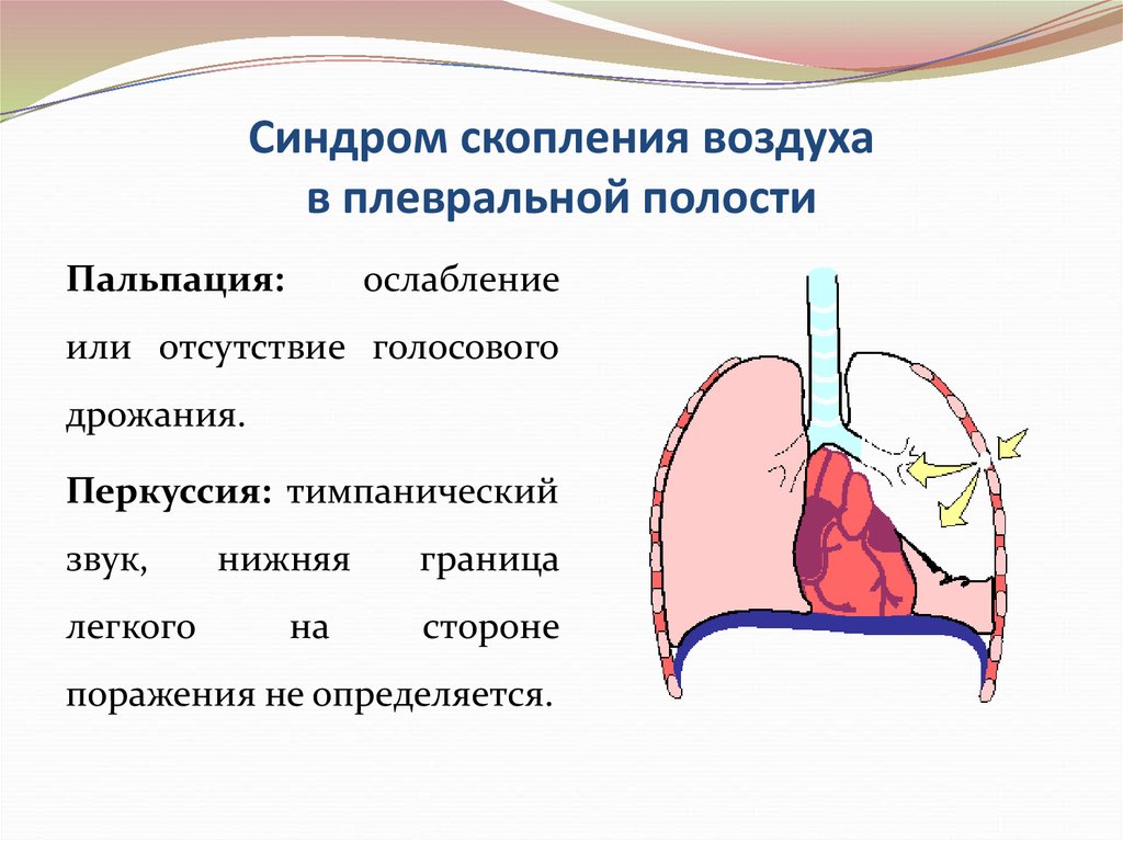 Синдром скопления жидкости. Синдром воздуха в плевральной полости. Скопление воздуха в плевральной полости. Синдром скопления жидкости и воздуха в плевральной полости. Синдром скопления воздуха в плевральной полости.