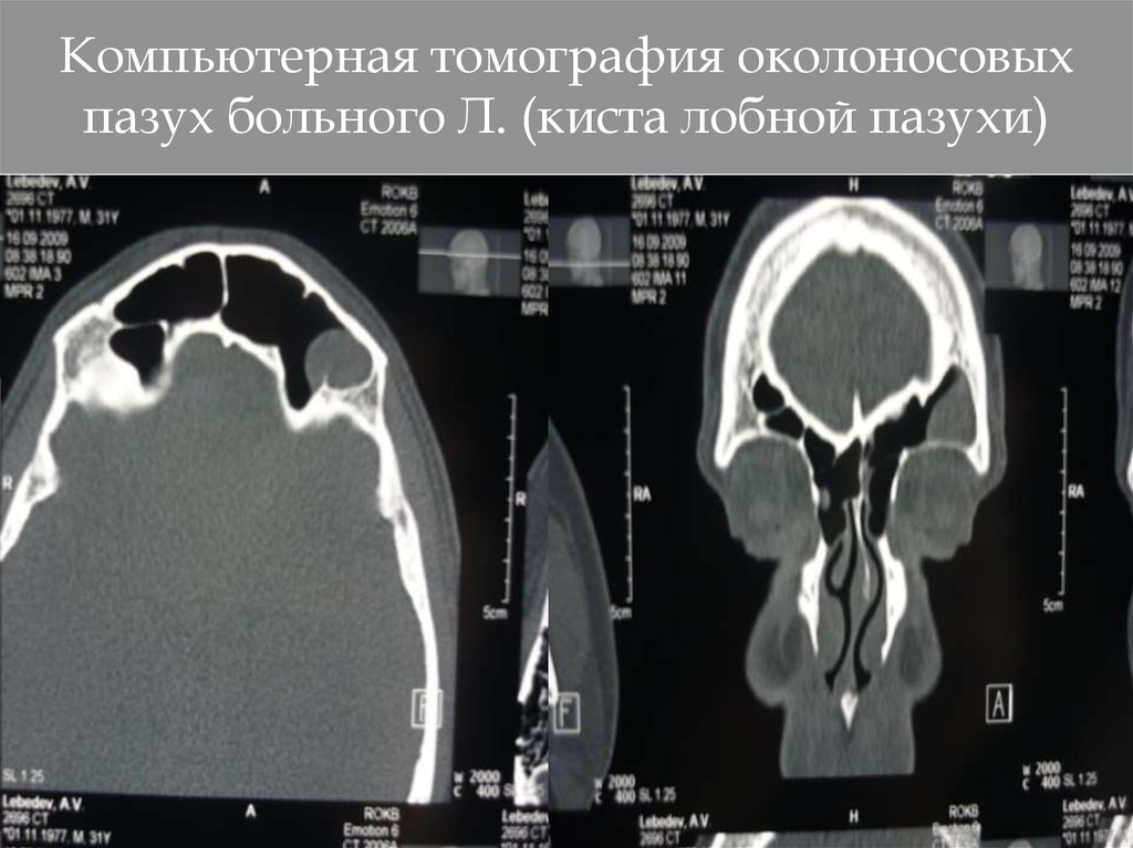 Кт околоносовой пазухи. Киста лобной пазухи мрт. Кт околоносовых пазух киста.