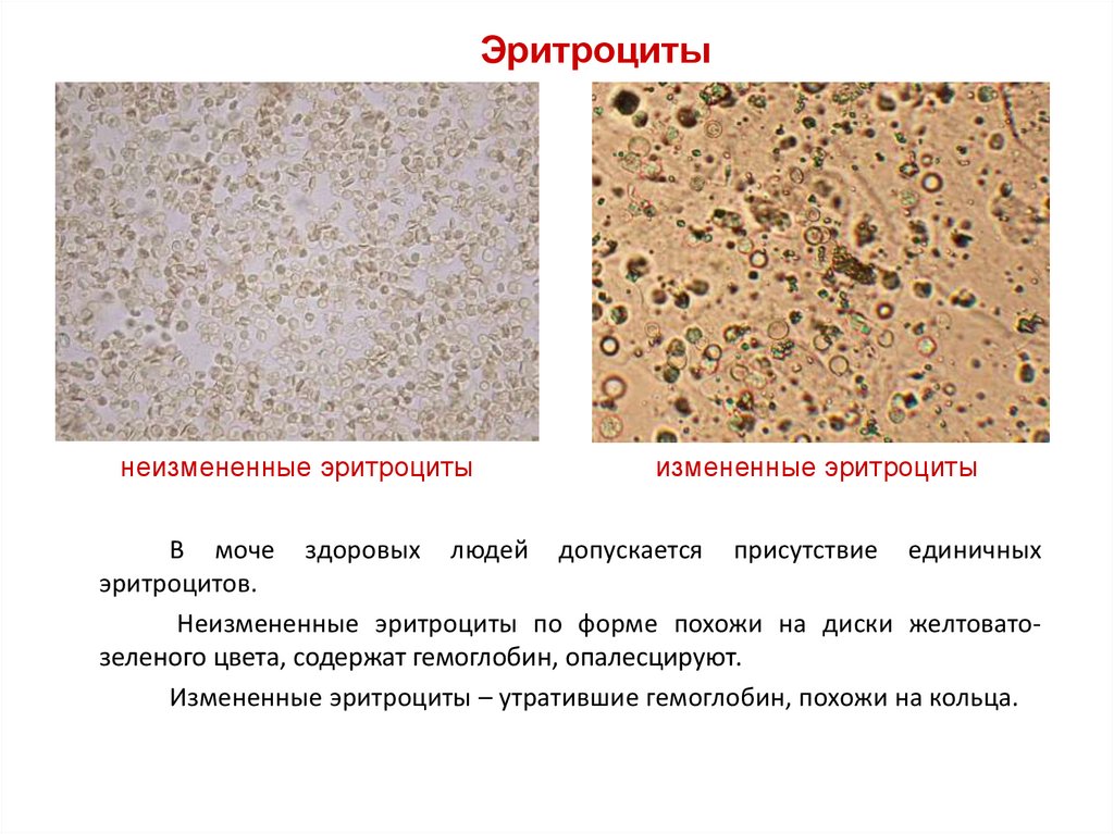 Появление эритроцитов в моче. Измененные и неизмененные эритроциты в моче микроскопия. Эритроциты выщелоченные микроскопия. Измененные эритроциты в моче. Изменённые и не изменённые эритроциты в моче.