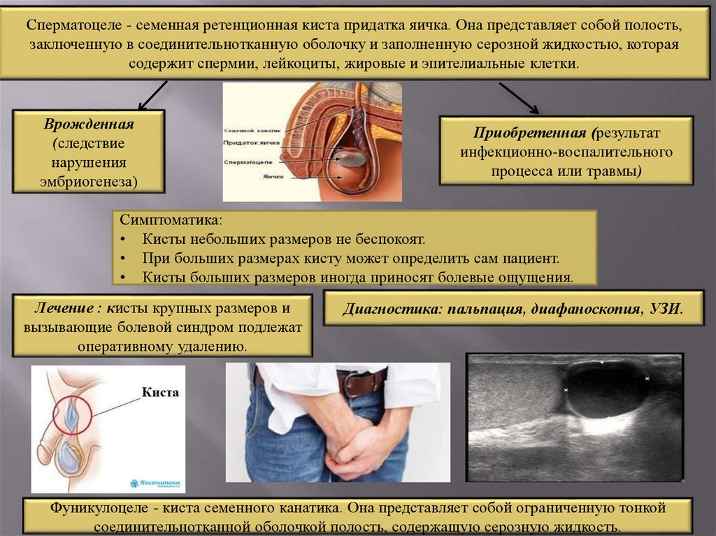 Лечение яичка. Энуклеация сперматоцеле. Киста (сперматоцеле) яичка. Заболевания наружных половых органов.