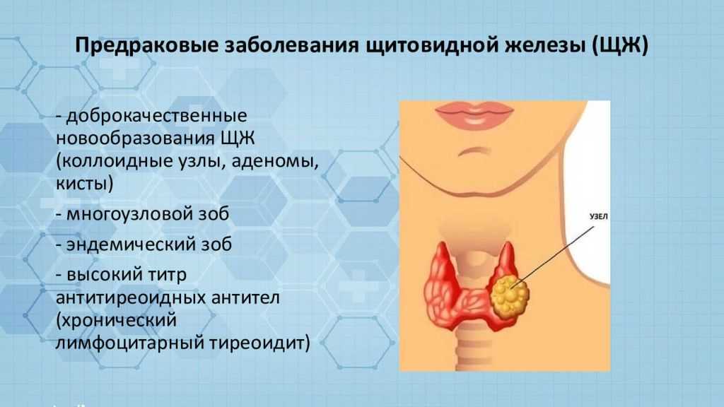 Признаки очаговых изменений щитовидной