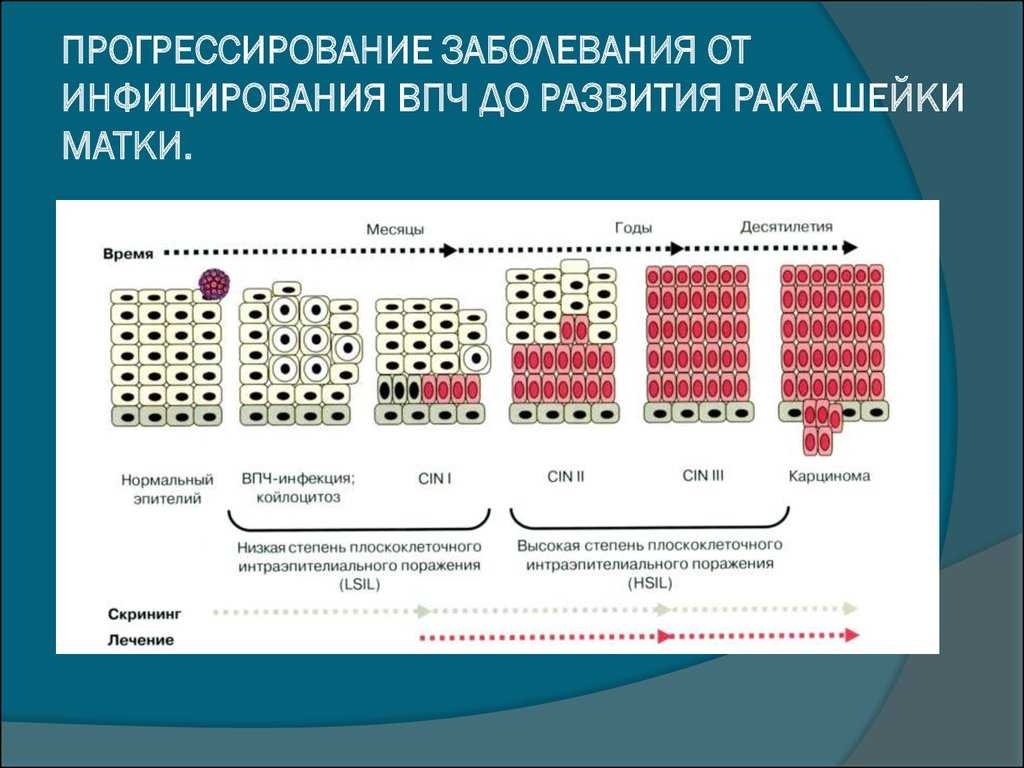 2 степень cin. Вирус папилломы человека стадии развития.