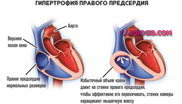 Желудочка сердца расширена. Гипертрофия левого предсердия и правого желудочка. Дилатация правого предсердия и правого желудочка. Дилятауия правого желудочка. Дилатация правого предсердия.