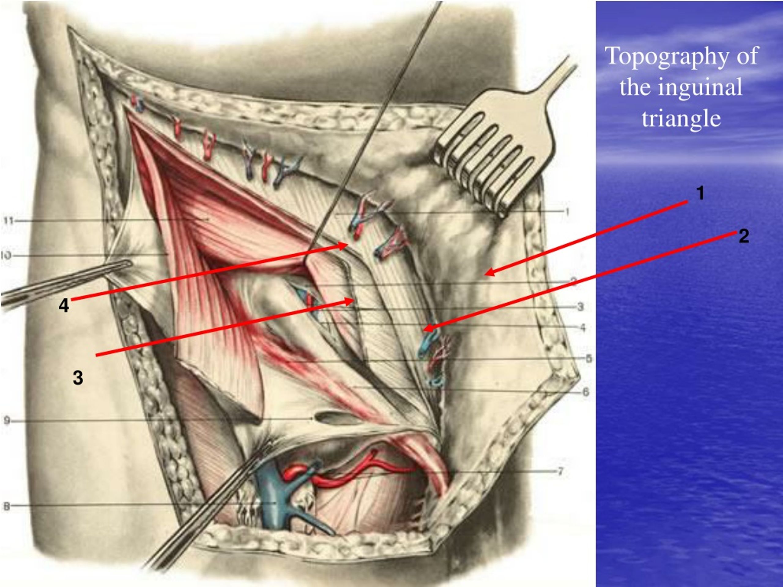 Операция на мышцы живота. Мышцы пахового канала анатомия. Хирургическая анатомия бедренных грыж. Мышцы живота и паховый канал анатомия. Передняя брюшная стенка топографическая анатомия грыжи.