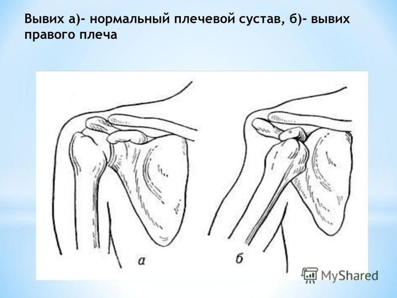 Вывих плеча. Подклювовидный вывих плечевой кости. Травматология вывих плечевого сустава. Передний подклювовидный вывих плеча.