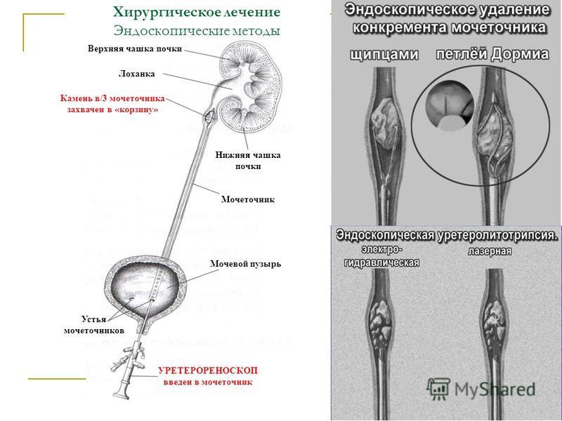 Болят почки после удаления камня