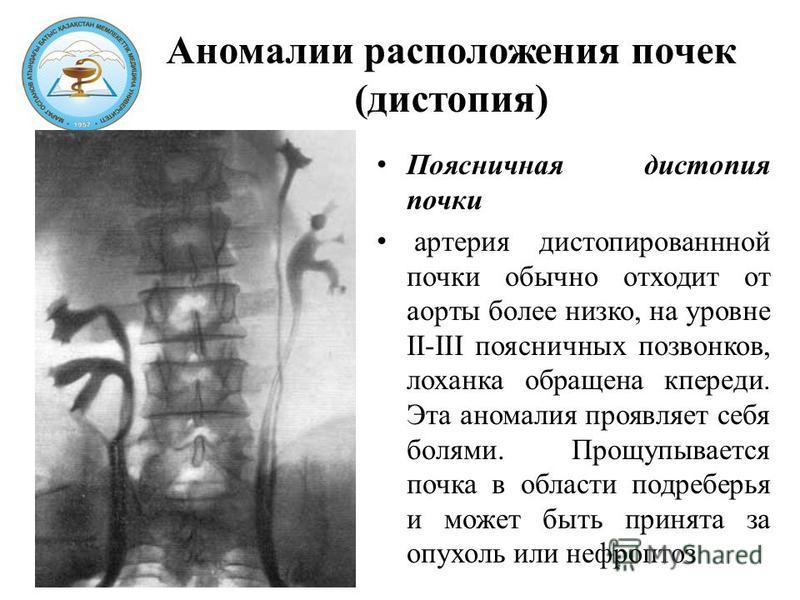 Аномалия развития почек презентация