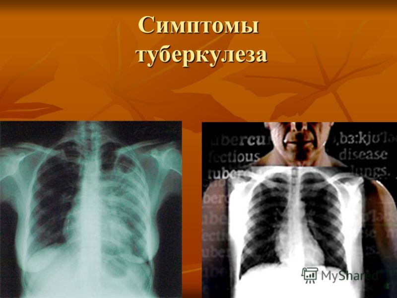 Какие симптомы туберкулеза у взрослых. Туберкулёз лёгких у взрослых. Начальные симптомы туберкулеза.