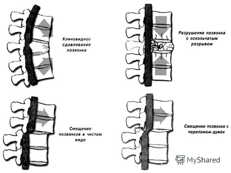 Смещение позвонков. Смещение позвонков грудного отдела. Смещение позвоночника в грудном отделе. Классификация смещения позвонков. Смещение 5 грудного позвонка.