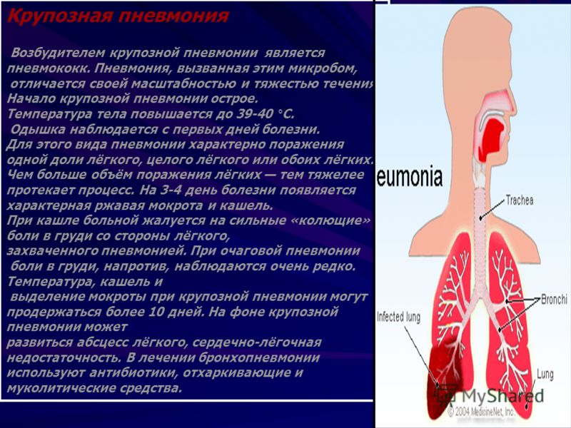 Может ли воспаление легких. Возбудитель крупозной пневмонии. Боли при заболеваниях легких. Боль при воспалении легких.