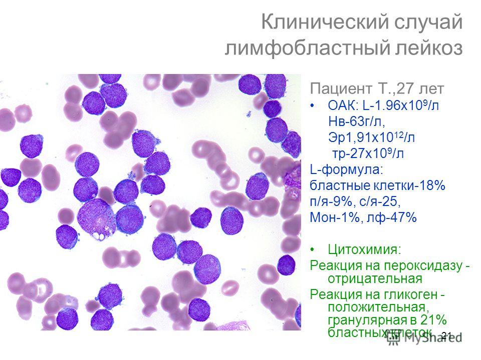 Острый лимфобластный т лейкоз. Острый лимфобластный лейкоз l1. Общий анализ крови при остром лимфобластном лейкозе.