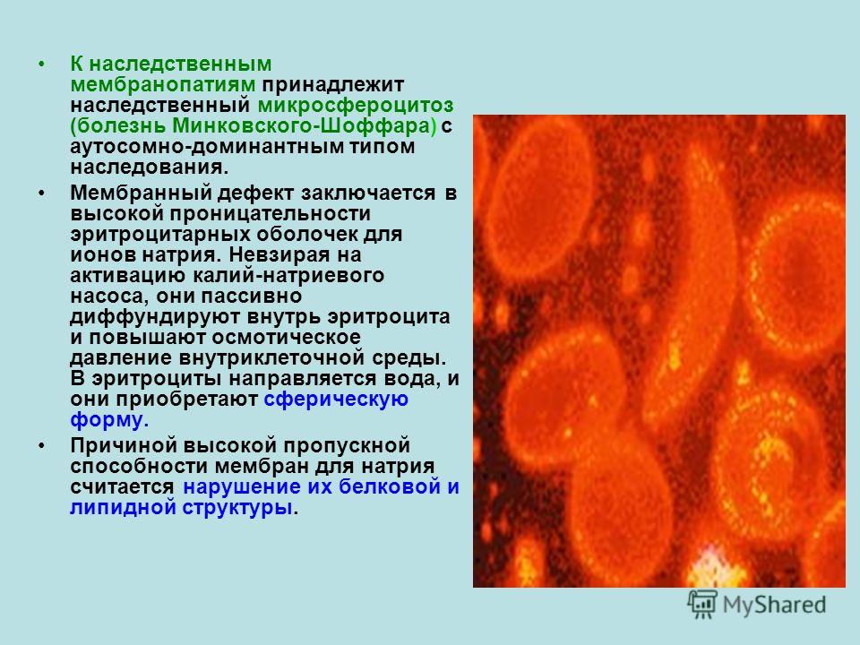 Анемия минковского шоффара у детей