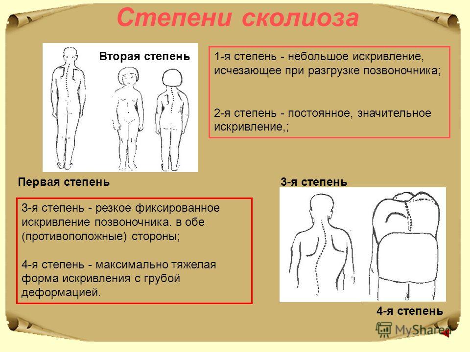 Степени искривления позвоночника