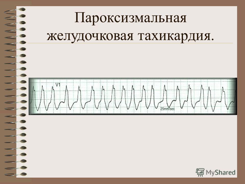 Желудочковая тахикардия лечение. Пароксизмальная тахикардия ЭКГ. Пароксизмальная желудочковая тахикардия на ЭКГ. Желудочковая тахикардия на ЭКГ. Наджелудочковая тахикардия на ЭКГ.