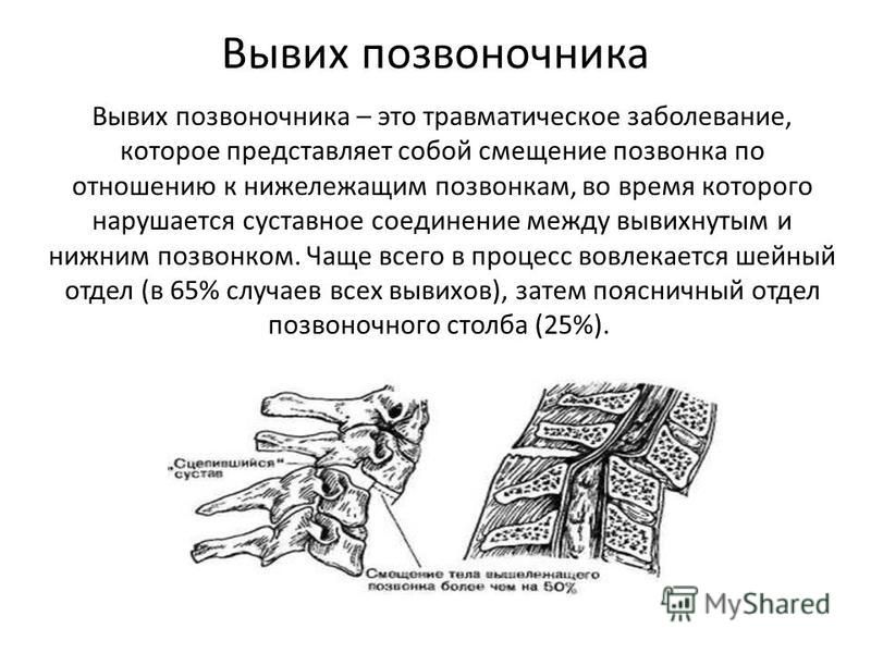 Смещение грудного позвонка