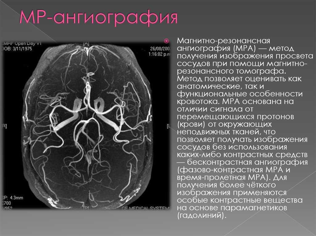 Ангиография. Мрт ангиограмма сосудов головного мозга. МРА (магнитно-резонансная ангиография). Магнитно-резонансная венография головного мозга. Кт ангиография патология.