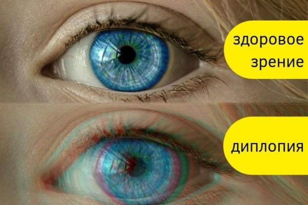 Двоение в одном глазу. Двоение в глазах. Нарушение зрения диплопия. Раздвоение зрения.
