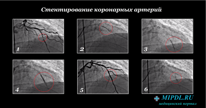 Жизнь после инфаркта и стентирования для мужчин. Инфаркт миокарда операция стентирование. Стентирование сердца при инфаркте миокарда. Этапы стентирования коронарных артерий. Терапия после стентирования коронарных артерий.