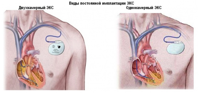 Экс что это. Электрокардиостимулятор 2 камерный. Однокамерный кардиостимулятор. Электрокардиостимулятор имплантируемый. Двухкамерный кардиостимулятор.