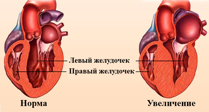 Увеличение лев желудочка. Гипертрофия миокарда левого желудочка сердца исход. Гипертрофия левого желудочка клиника. Левый желудочек.