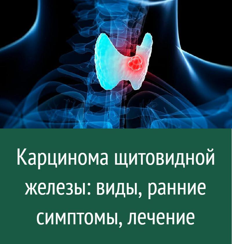 Онкология щитовидной. Карцинома щитовидной железы. Онкология щитовидной железы. Онкология щитовидной железы симптомы. Онкология щитовидки симптомы.