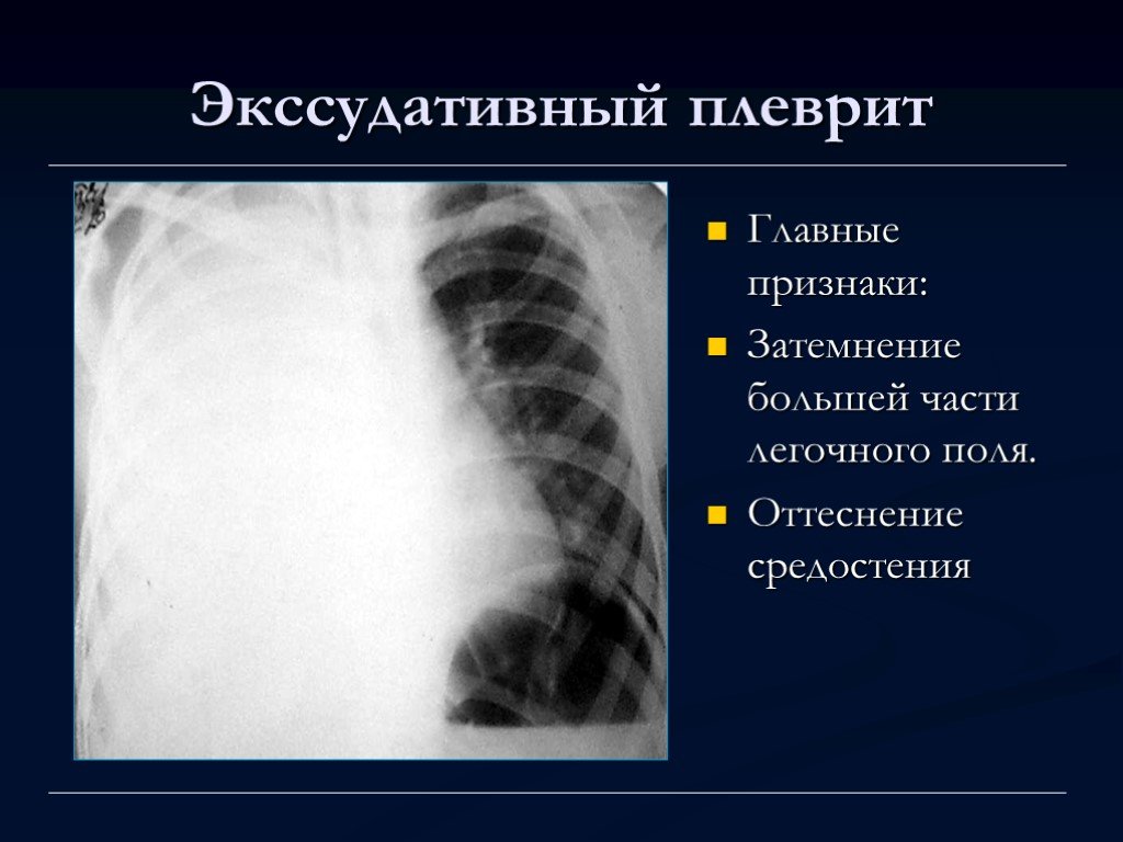 Туберкулез плеврит презентация