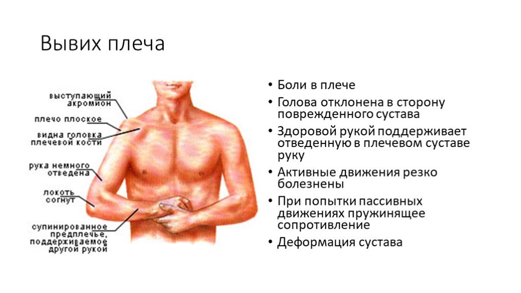 Костя ломит. Признаки вывиха плечевого сустава. Привычный вывих плеча симптомы. Симптом при вывихе травматического плеча. Привычный вывих плечевого сустава как понять.