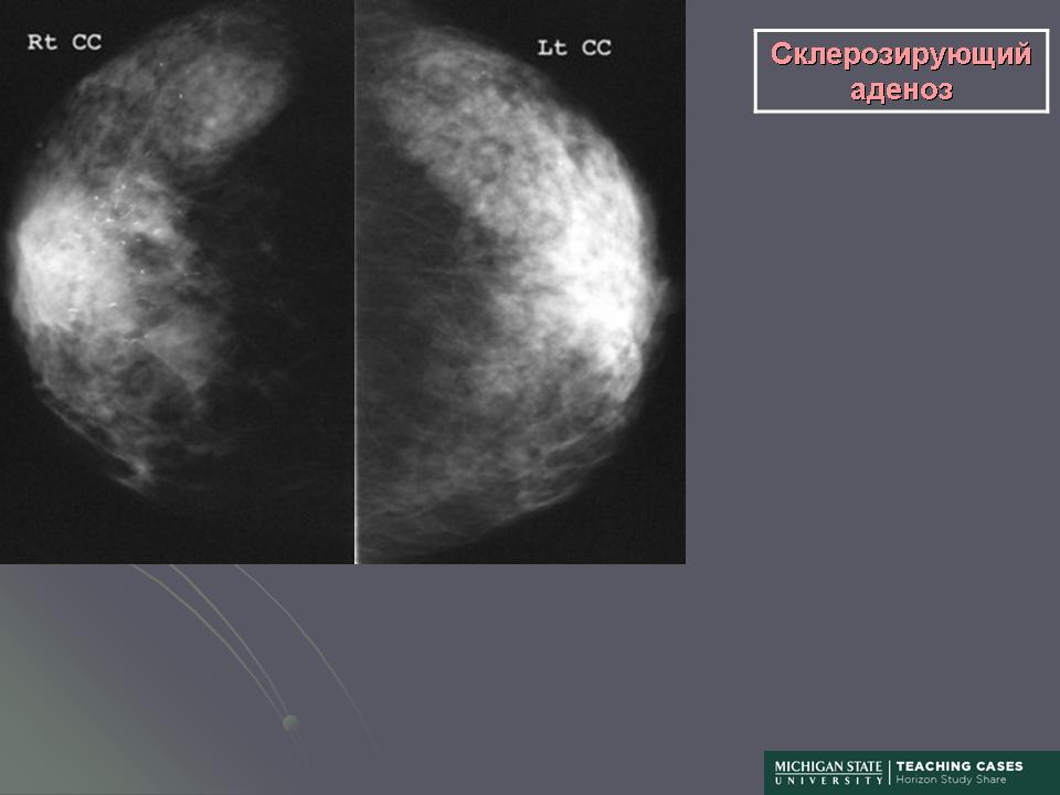 Форум молочной железы. Склерозирующий аденоз молочных желез на маммографии. Склерозирующий аденоз молочной железы на рентгене. Аденоз молочной железы рентген.