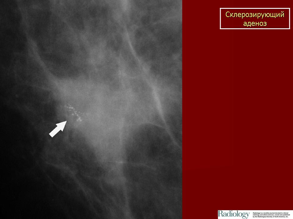 Аденоз на маммографии