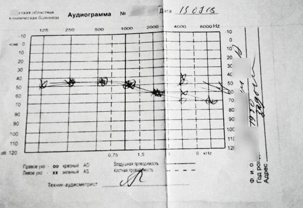 Аудиограмма слуха