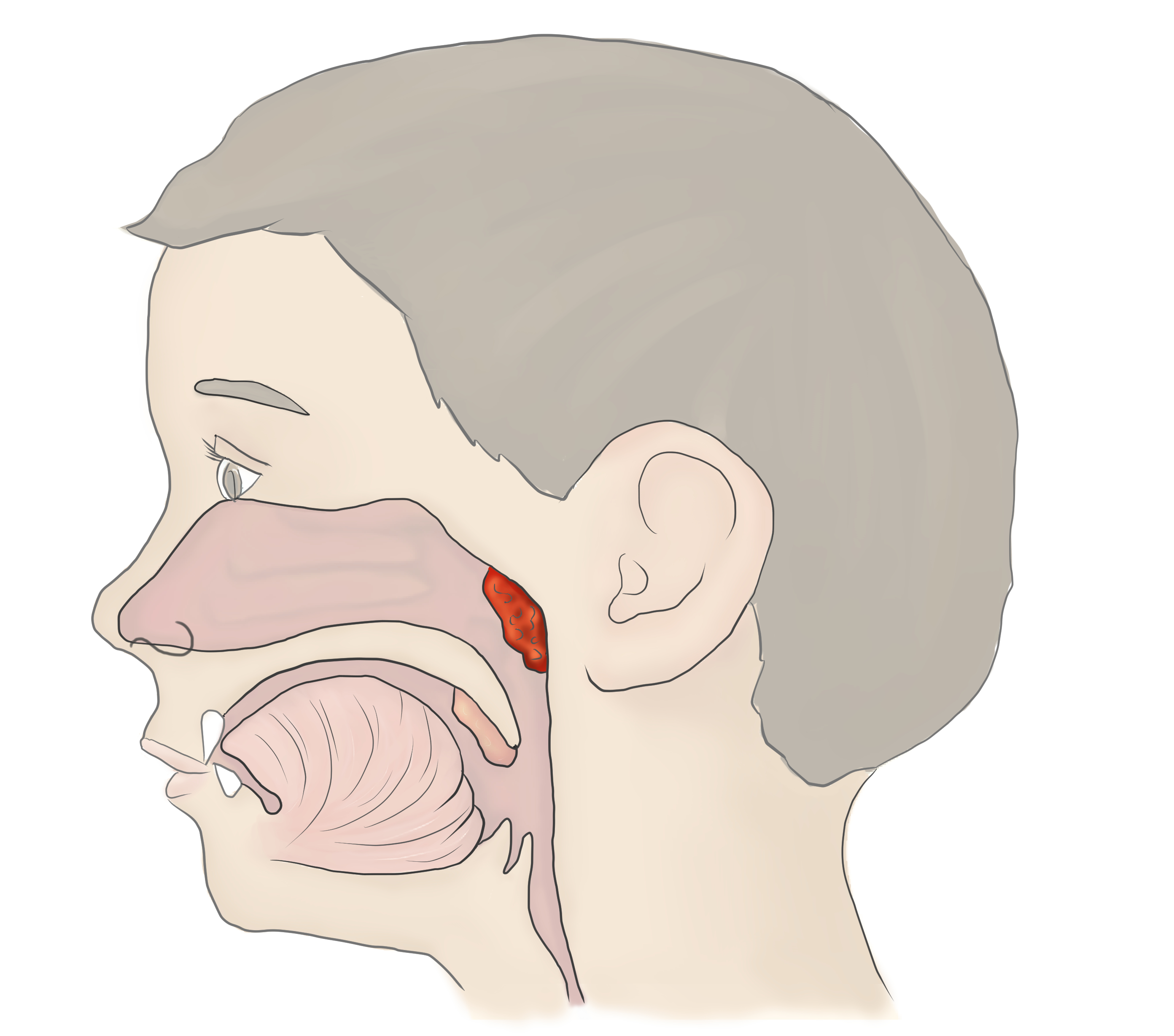 Гипертрофия носоглоточной миндалины