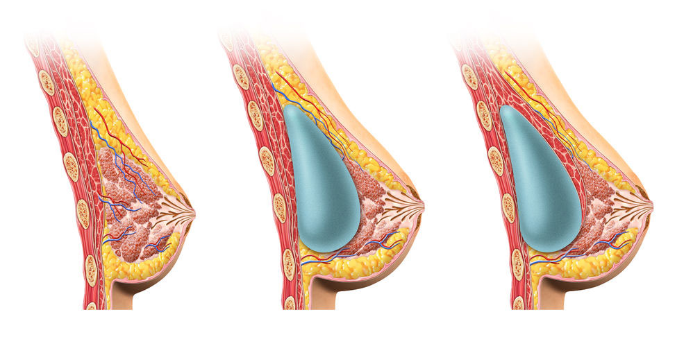 A diagram showing the position of a breast implant both above and below the muscle layer