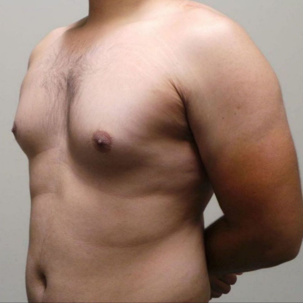изменение груди у мужчин фото 33